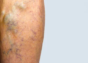 Vein Diseases Ferrer & Monaghan Vein and Aesthetic Center