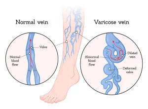 Case: Young Female With Varicose Veins & Leg Swelling - HeartVein NYC