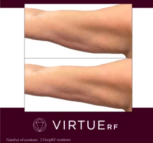 VirtueRF Microneedling