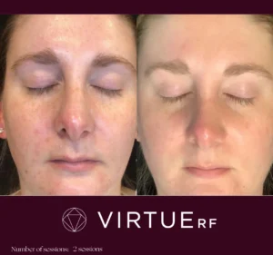 VirtueRF Microneedling