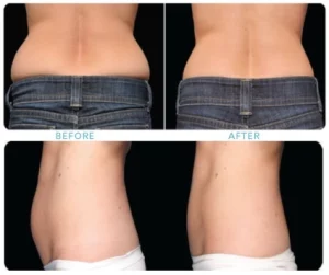 Coolsculpting Ferrer & Monaghan Vein and Aesthetic Center