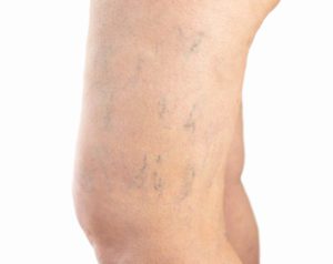 Vein Diseases Ferrer & Monaghan Vein and Aesthetic Center