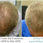 48-Year-Old Male Hair PRP Treatment Results