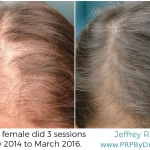 19-Year-Old Female Hair PRP Treatment Results
