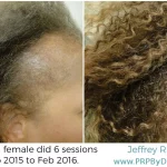 43-Year-Old Female Hair PRP Treatment Results