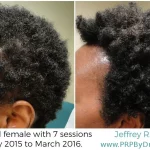 45-Year-Old Female Hair PRP Treatment Results