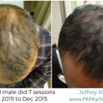 56-Year-Old Male Hair PRP Treatment Results