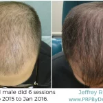 25-Year-Old Male Hair PRP Treatment Results