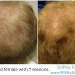 82-Year-Old Female Hair PRP Treatment Results