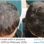 40-Year-Old Male Hair PRP Treatment Results