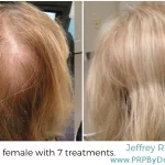 64-Year-Old Female Hair PRP Treatment Results