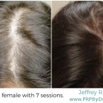 48-Year-Old Female Hair PRP Treatment Results