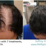 38-Year-Old Male Hair PRP Treatment Results