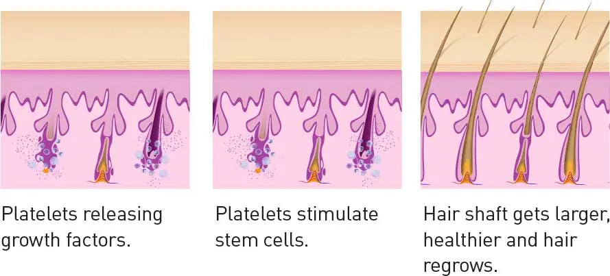 PRP Hair Growth Platelets