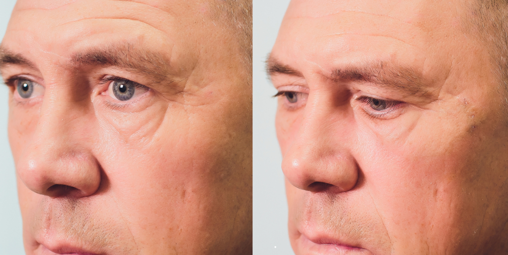 Uncovering the Benefits of PDO Thread Lift Treatments | Ferrer